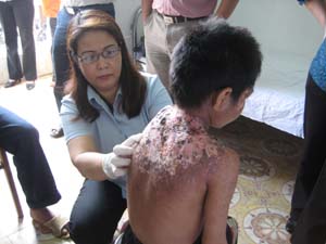 Các bác sỹ Viện Da liễu quốc gia khám cho bện hnhân Xa Văn Tâm, xóm Chiềng Cang, xã Mường Chiềng là một trong số 7 bệnh nhân còn sống trên địa bàn.
